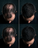 Fibre HairLift aplicare pe zone rare păr — before after